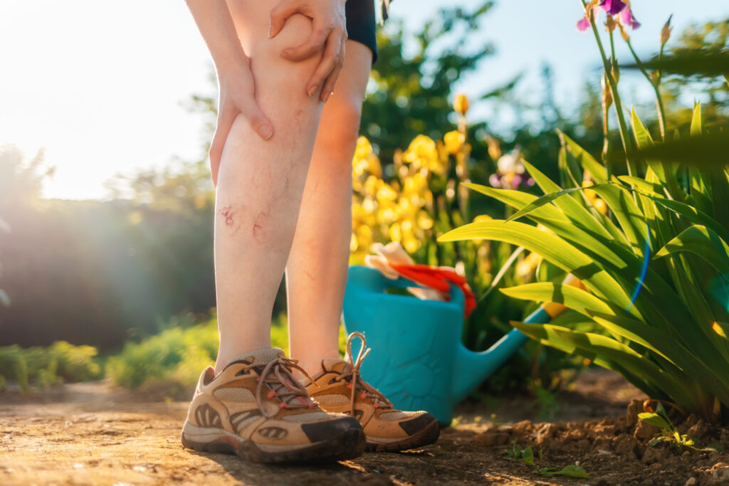 Swollen Legs and Varicose Veins