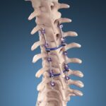 After Surgery, I Am Now Metal Mom